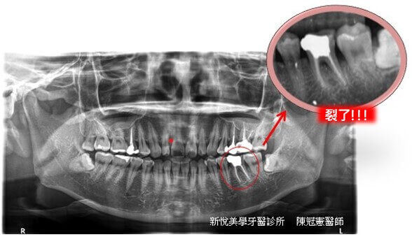 牙裂植牙重建案例的第1張圖片