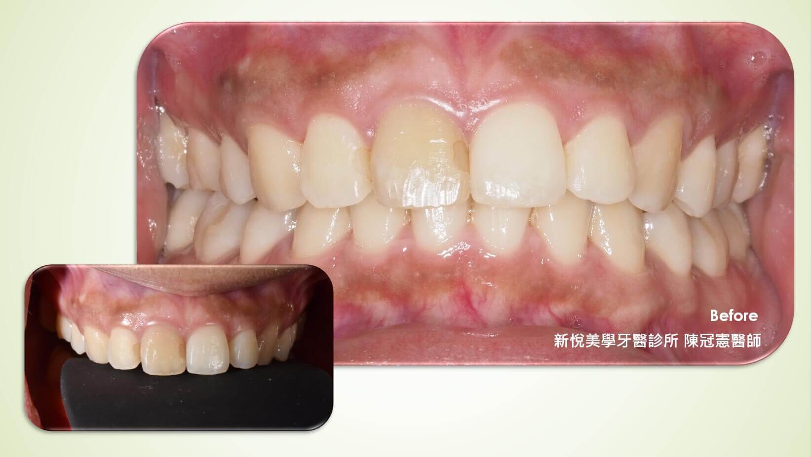 做完根管治療後才會有牙齒變黑的情況嗎？的第2張圖片