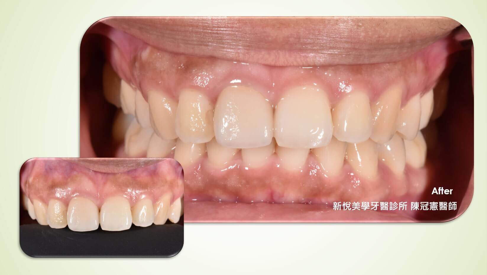 做完根管治療後才會有牙齒變黑的情況嗎？的第3張圖片
