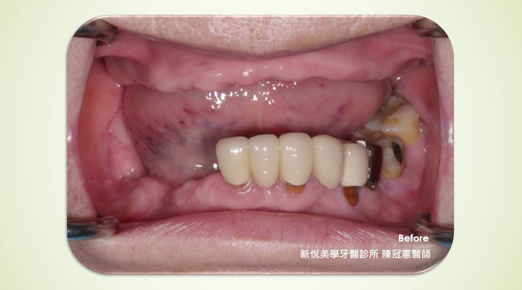 哪種情況較適合選擇活動假牙呢?的第2張圖片