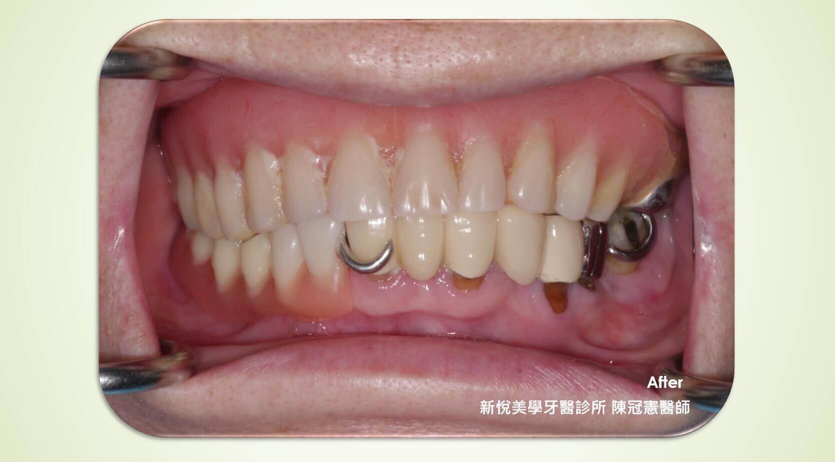 哪種情況較適合選擇活動假牙呢?的第3張圖片