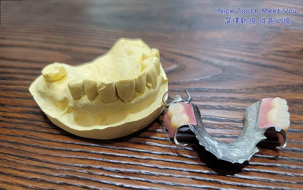 活動式假牙有不可被取代的特色！　新悅美學牙醫診所的第2張圖片