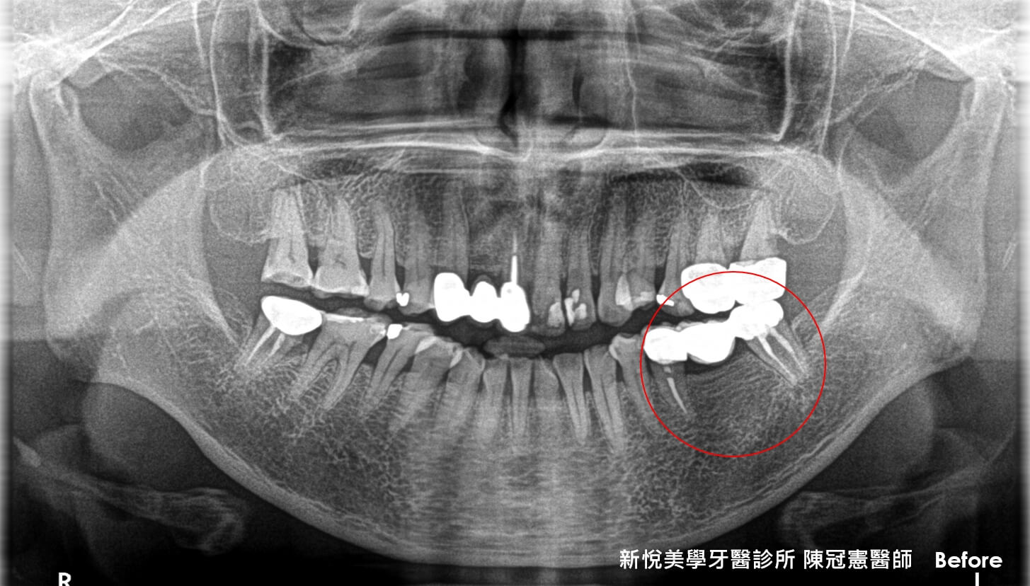 你是否口腔內也有鬆脫了又黏回去的假牙問題呢？　新悅美學牙醫診所的第2張圖片