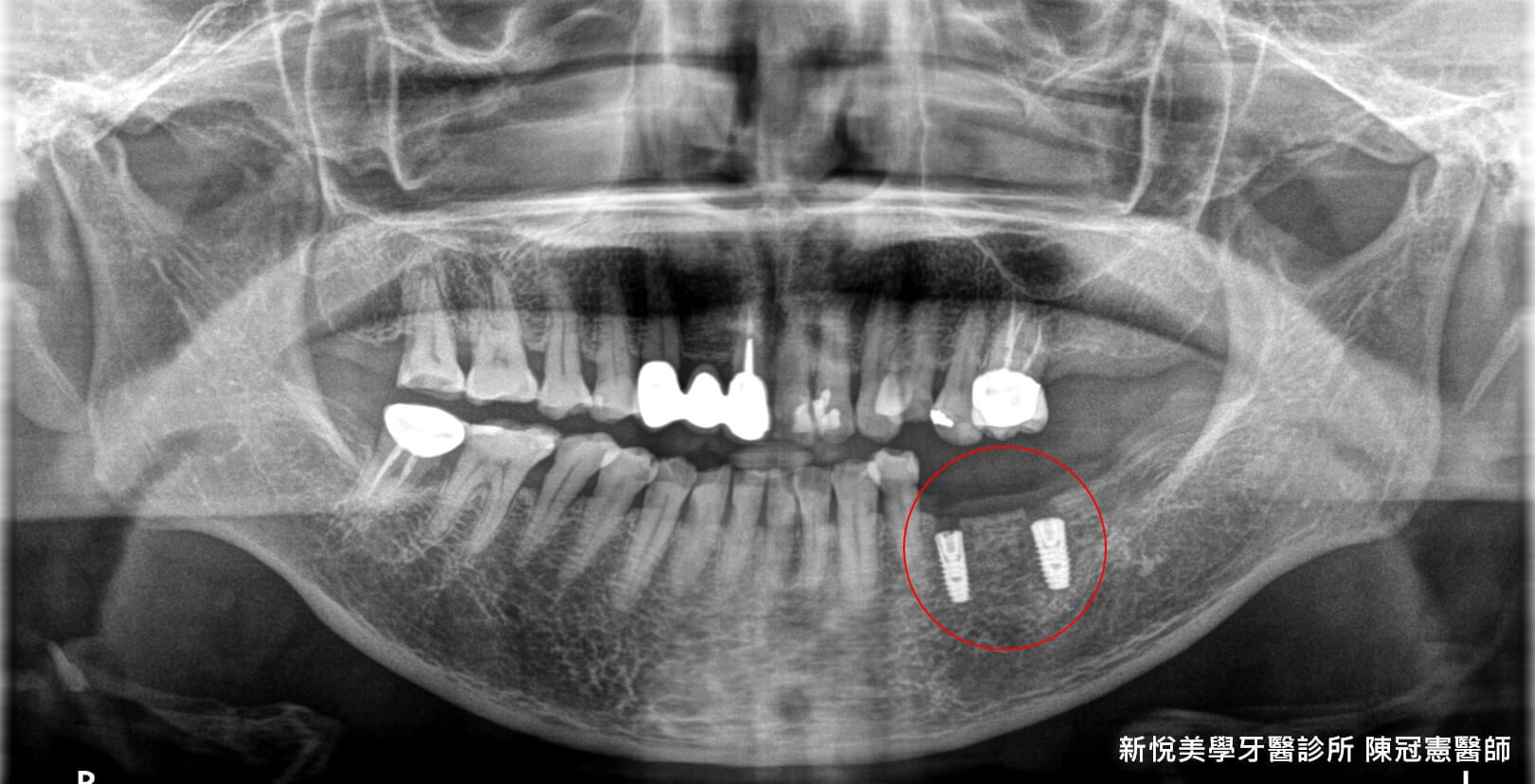 你是否口腔內也有鬆脫了又黏回去的假牙問題呢？　新悅美學牙醫診所的第3張圖片