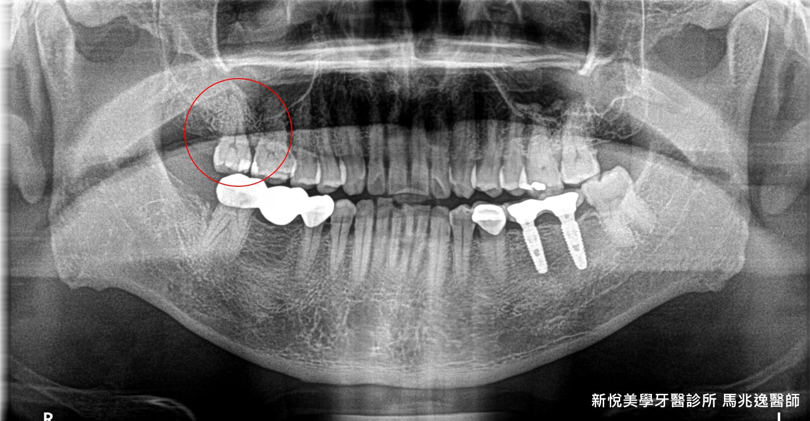 牙齒磨耗到斷裂該如何重建呢？　新悅美學牙醫診所的第2張圖片
