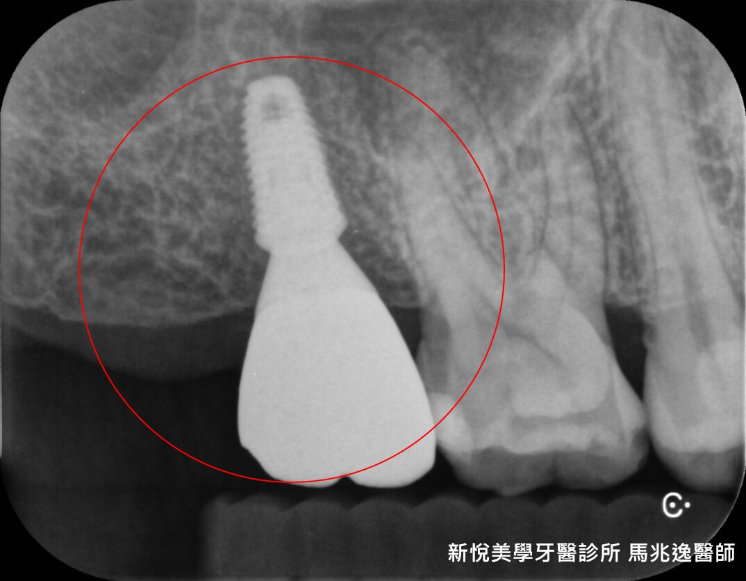 牙齒磨耗到斷裂該如何重建呢？　新悅美學牙醫診所的第3張圖片