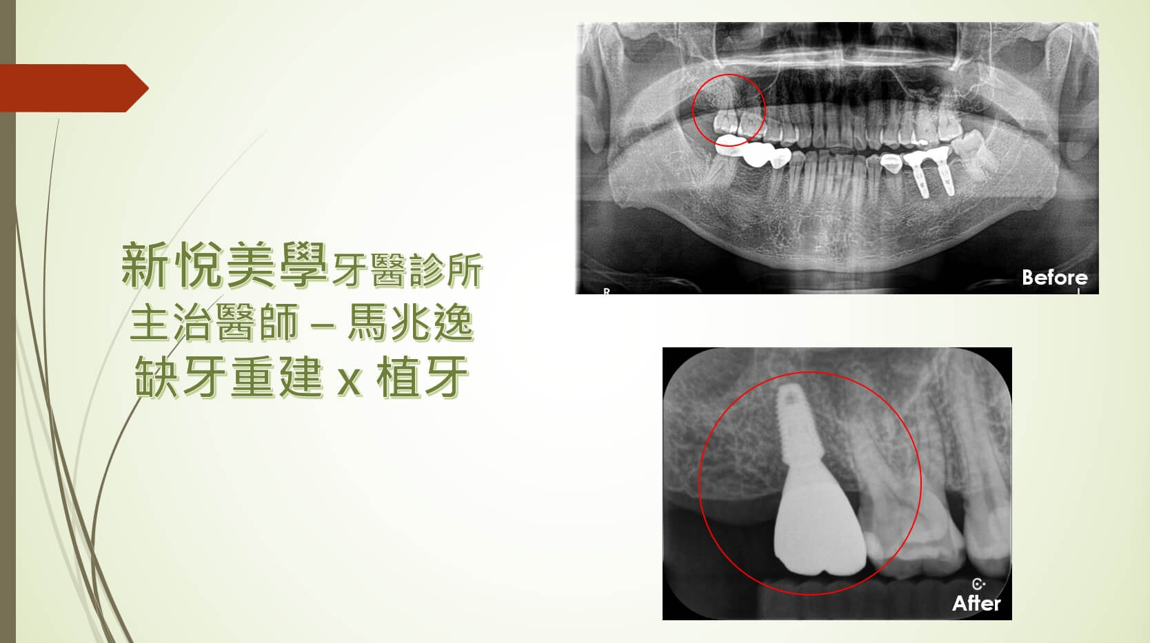牙齒磨耗到斷裂該如何重建呢？　新悅美學牙醫診所的第1張圖片