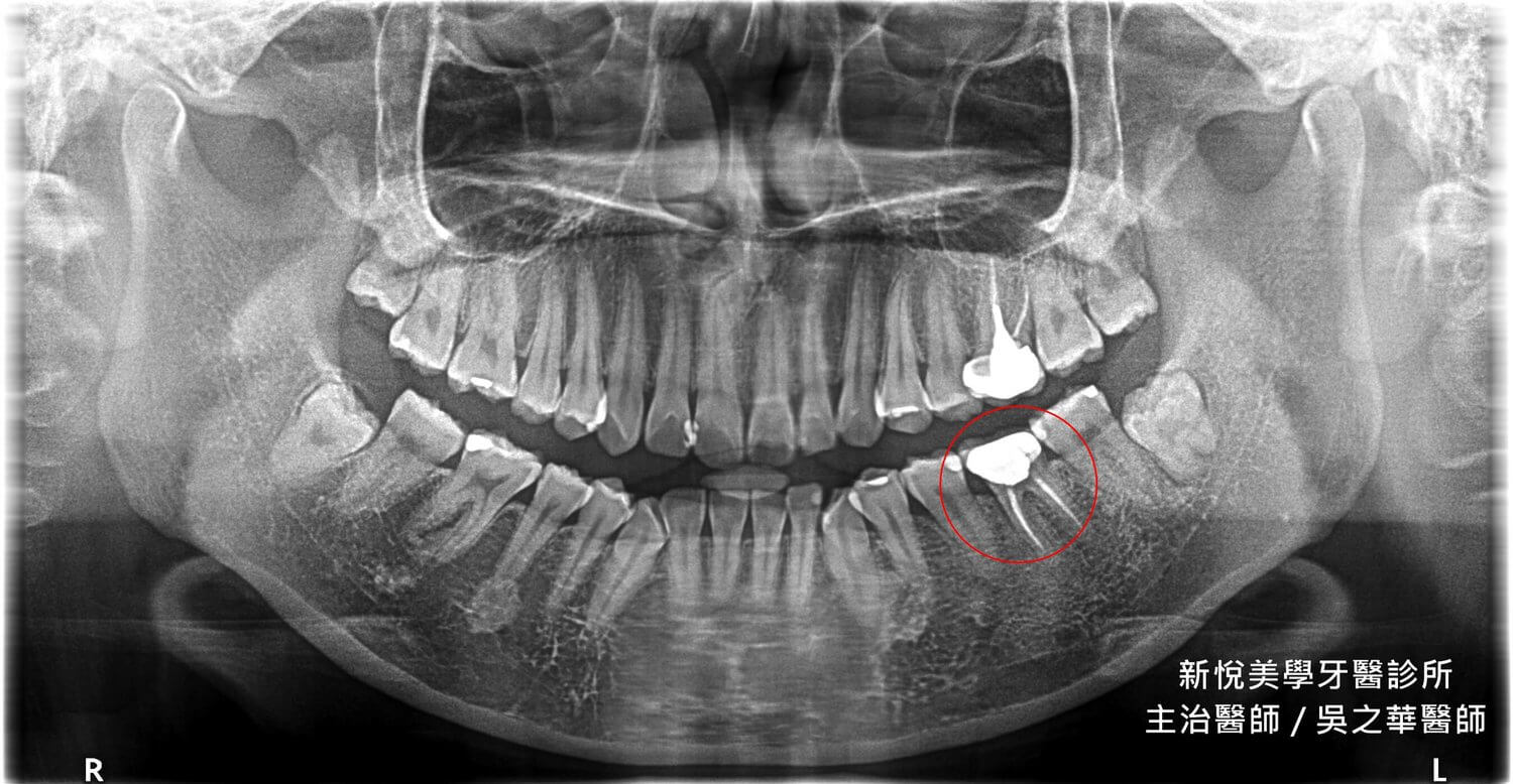 假牙掉下來，發現剩下的齒質已經不到一半怎麼辦！？　新悅美學牙醫診所的第2張圖片