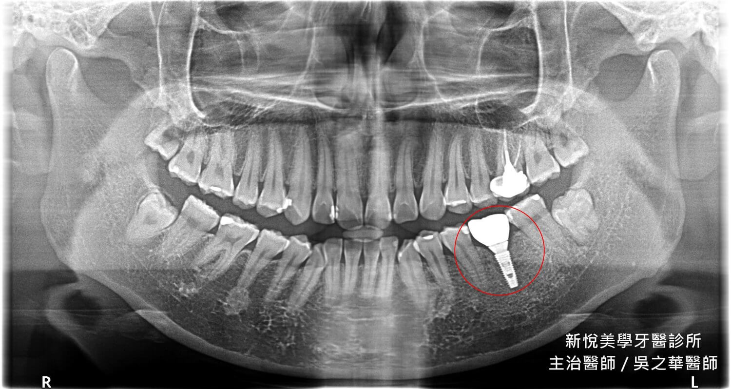 假牙掉下來，發現剩下的齒質已經不到一半怎麼辦！？　新悅美學牙醫診所的第3張圖片