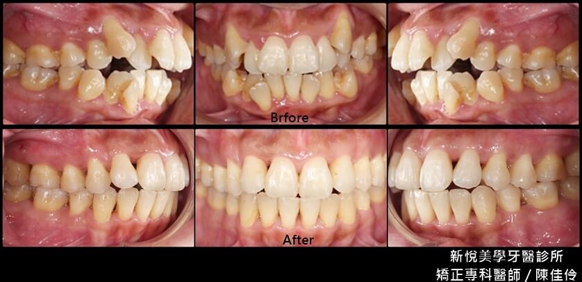 虎牙暴出、牙齒擁擠凌亂透過矯正最後的變化讓你為之一亮！　新悅美學牙醫診所的第2張圖片