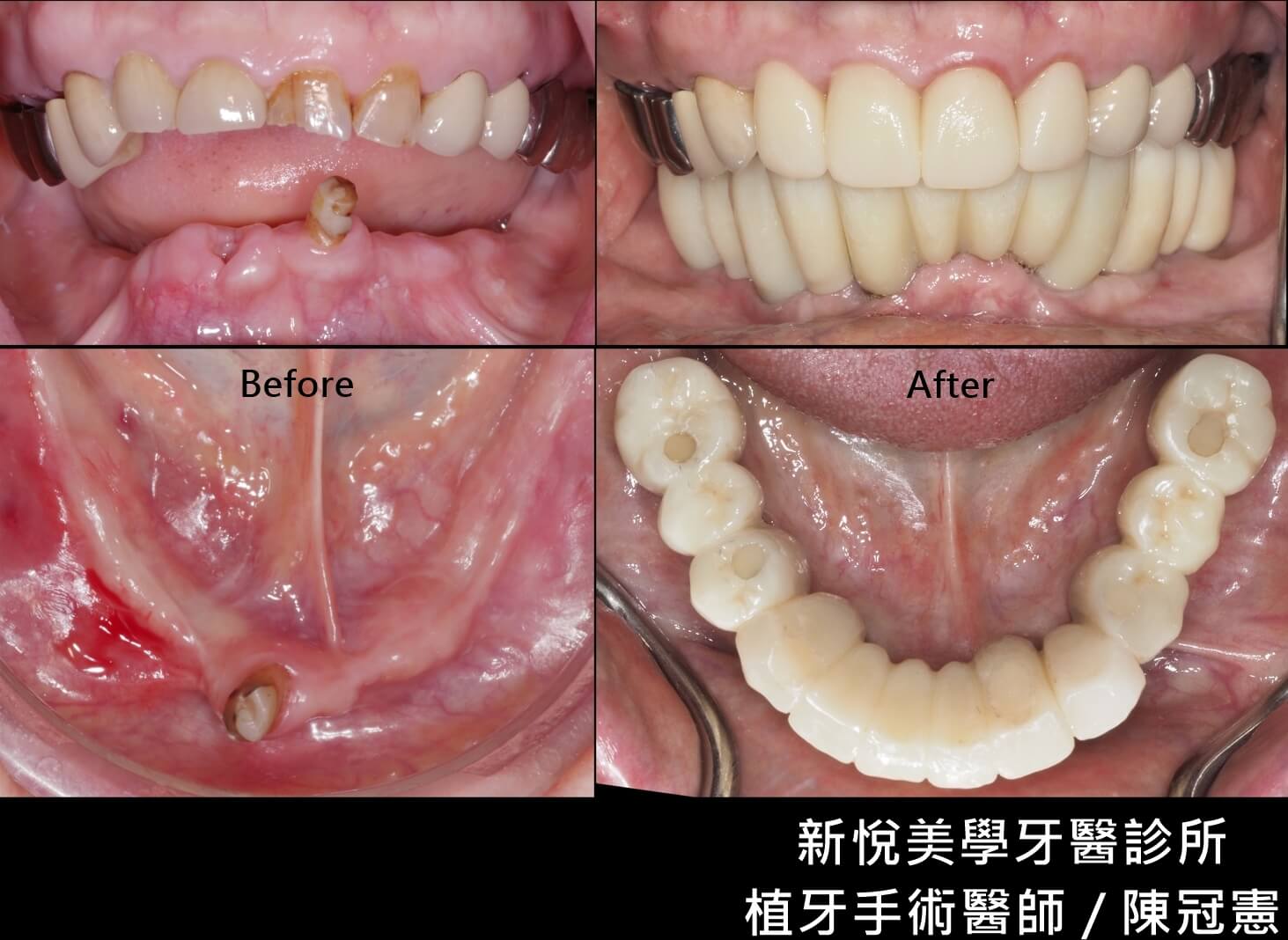 缺牙不僅失去了笑容也失去了健康！ 新悅美學牙醫診所的第2張圖片