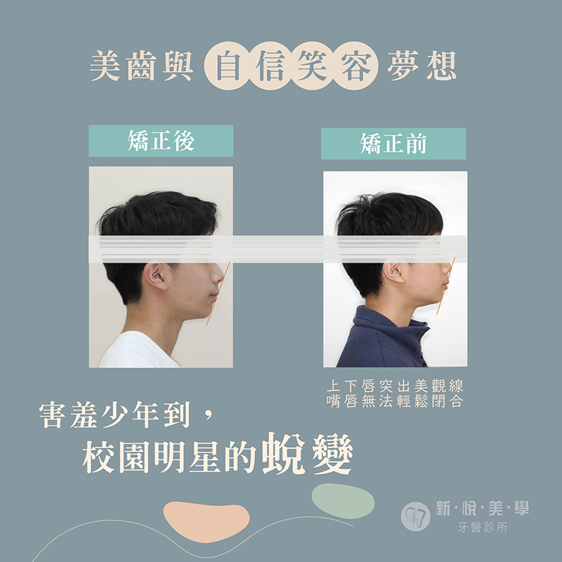 透明牙套矯正優點大公開，沒人看得出來的自信蛻變的第2張圖片