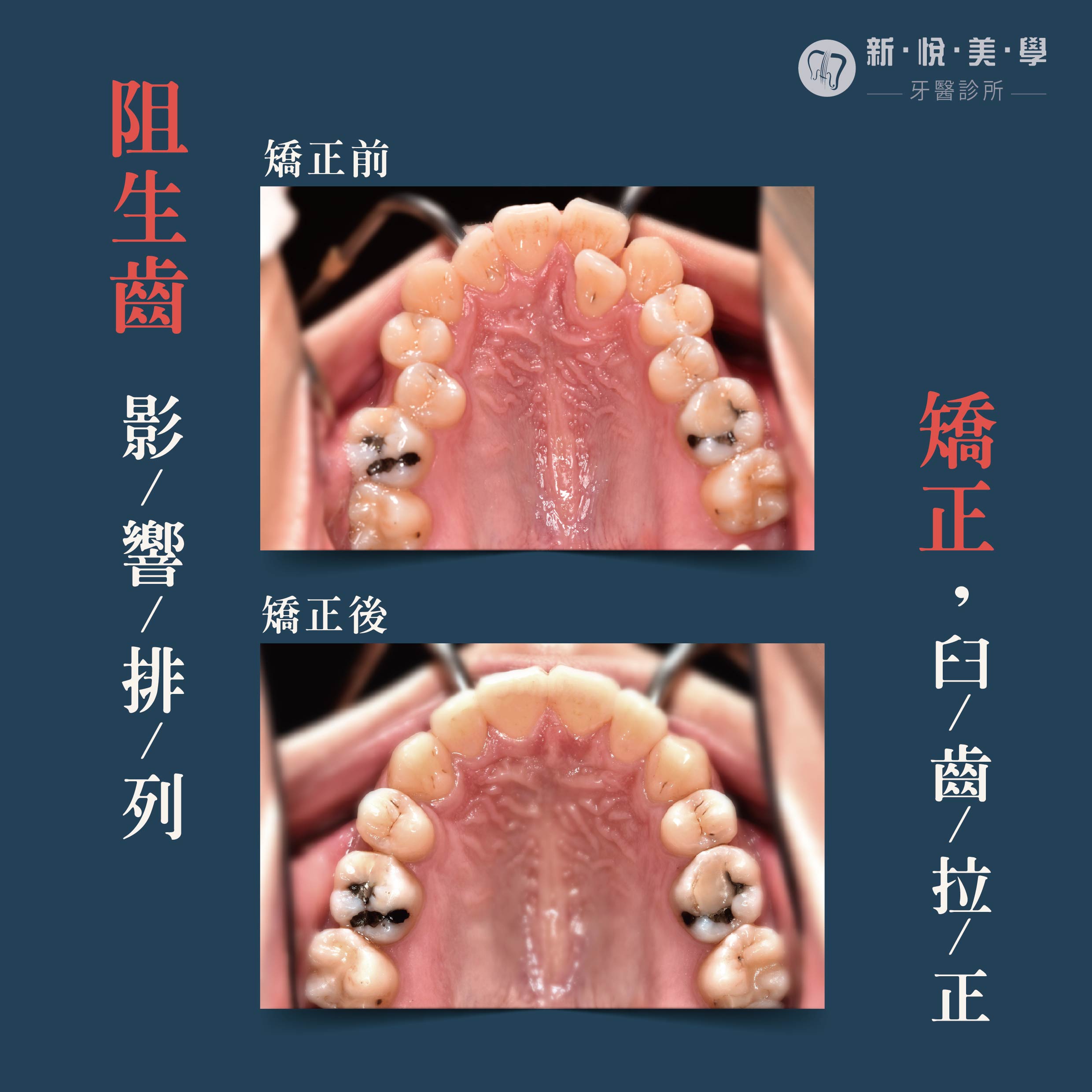 下顎臼齒傾倒與阻生牙矯正實例的第2張圖片