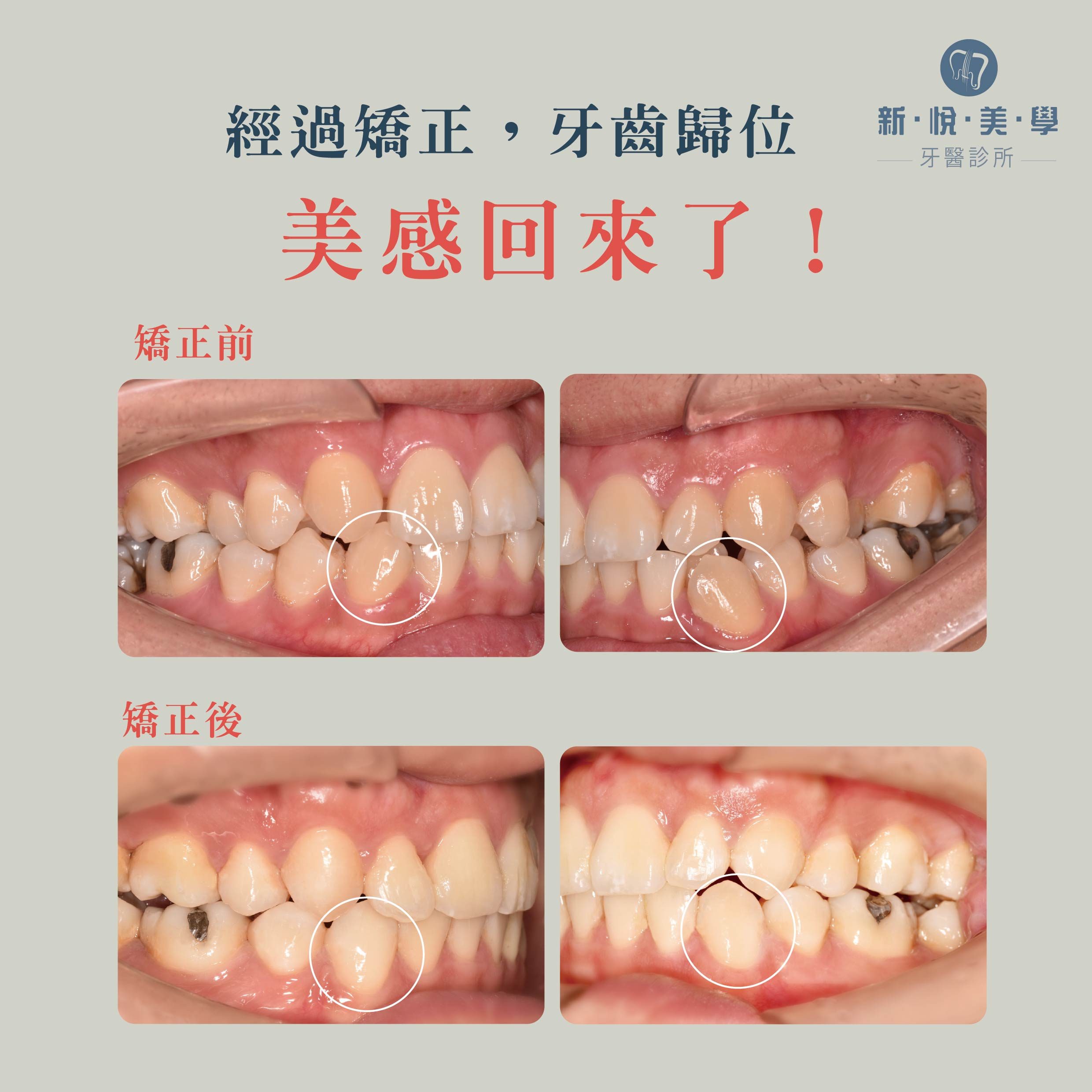 下顎臼齒傾倒與阻生牙矯正實例的第3張圖片