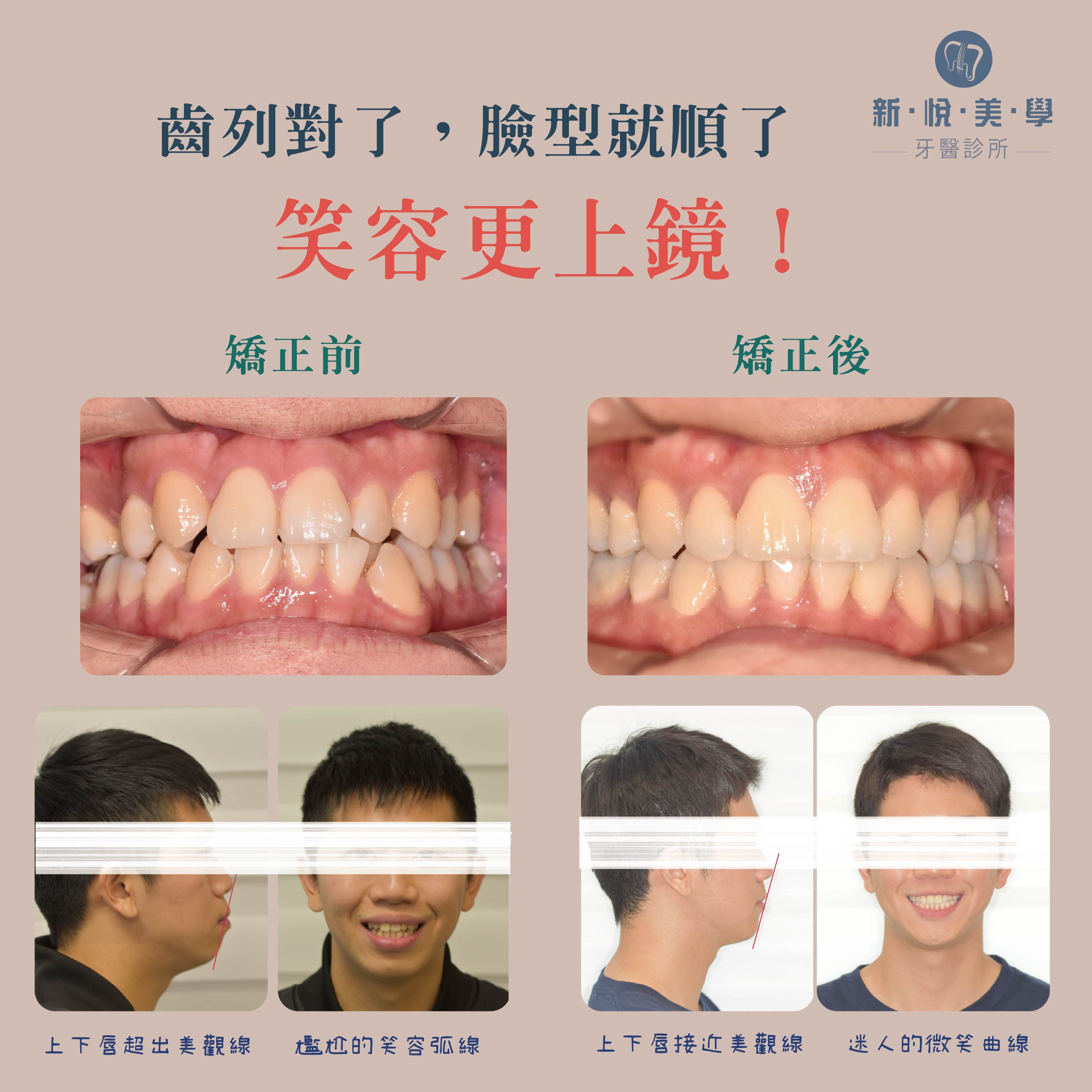 下顎臼齒傾倒與阻生牙矯正實例的第4張圖片