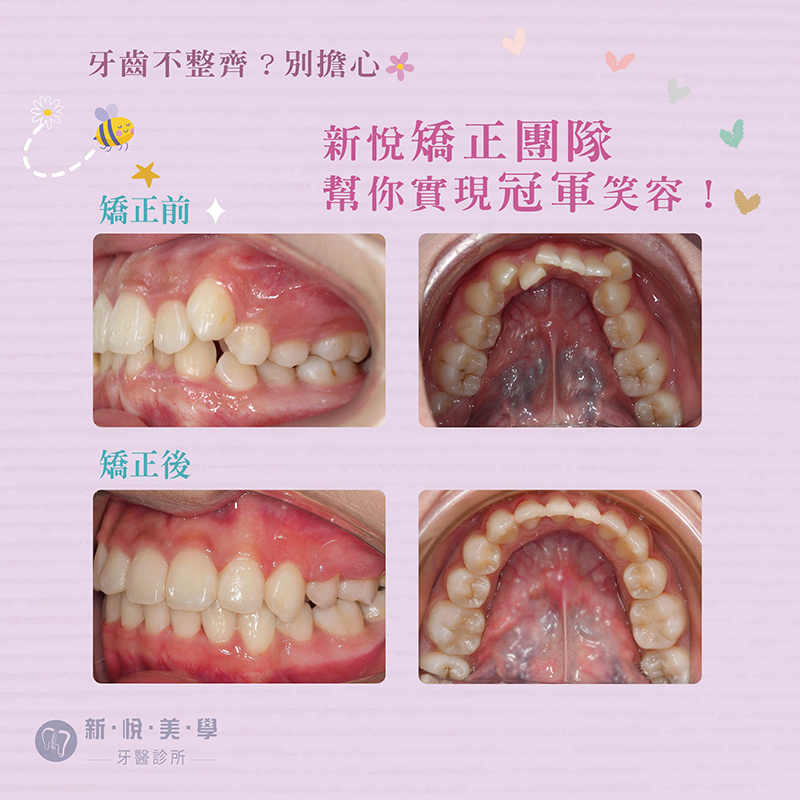 從「teeth卡卡」變身運動場上最閃亮的笑的第2張圖片
