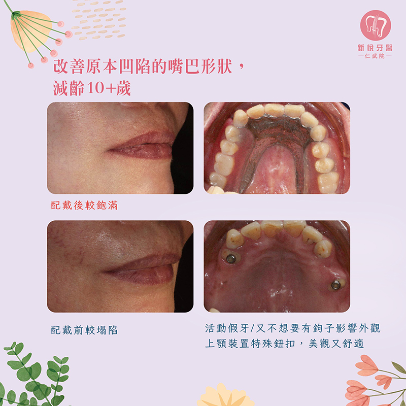 抽菸＋牙周病導致牙齒損壞？活動假牙幫助麗香重獲新生的第2張圖片