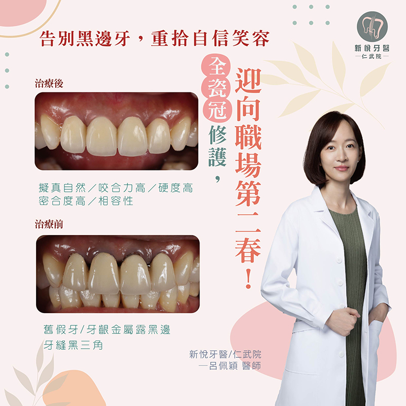 告別黑邊牙，迎向職場第二春的第1張圖片